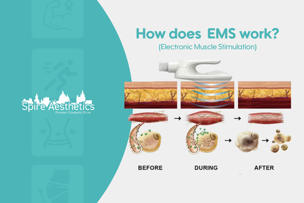 EMS treatment for post pregnancy weight loss treatment Atherstone