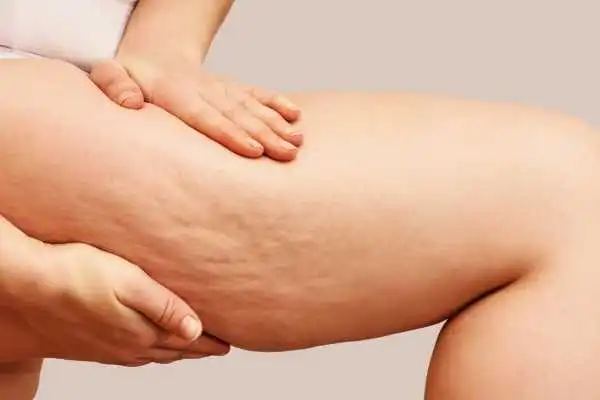 Image of woman showing leg with cellulite Atherstone