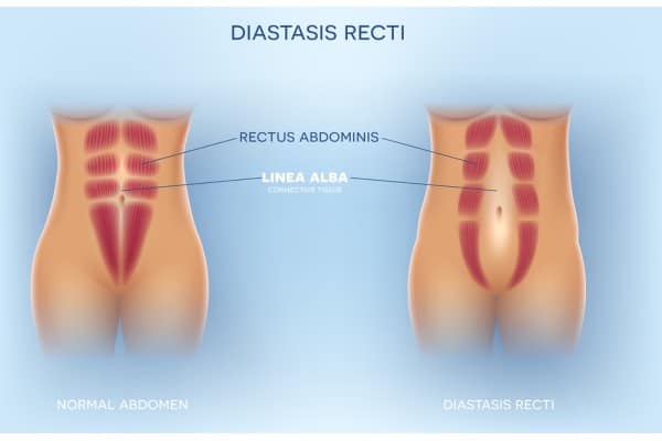 What Non-Surgical Options Are Available for Diastasis Recti Atherstone?