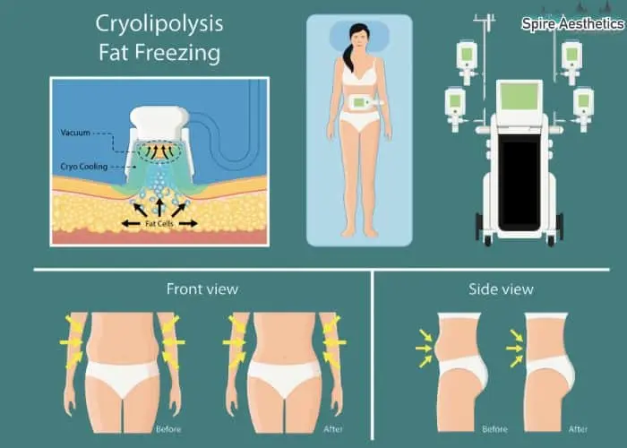 Fat freezing treatment Atherstone benefits for competitions to remove stubborn fat deposits.
