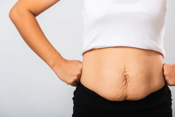 Image of a woman's stomach after weight loss with sagging skin following a gastric band Atherstone