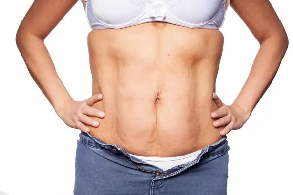 sagging skin on woman's stomach after weight loss injections Atherstone