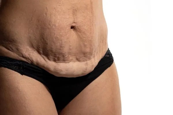 Image of womans stomach after weight loss injections Atherstone showing saggy skin