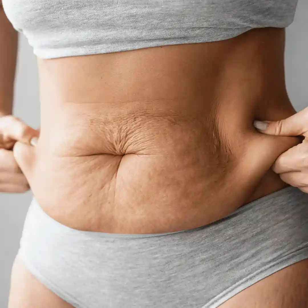 Is It Normal to Have Loose Skin After Pregnancy Atherstone?