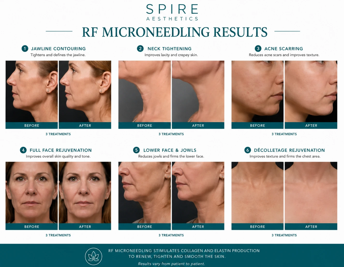 RF Microneedling Skin tightening Atherstone results