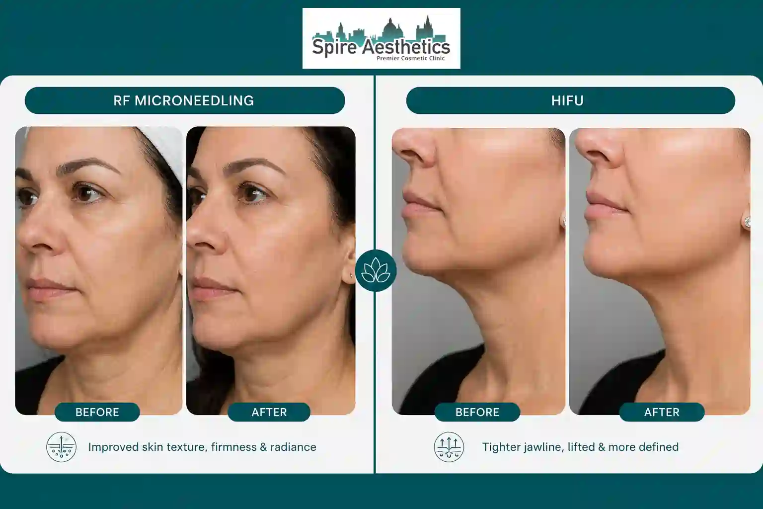 Can RF Microneedling and HIFU Be Combined Atherstone?