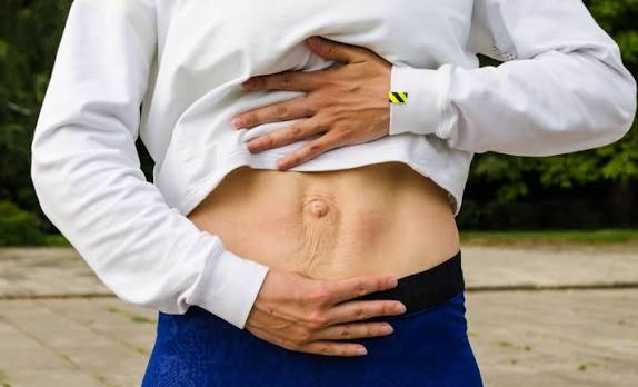 When Could Diastasis Recti Be the Missing Piece of the Puzzle Atherstone?
