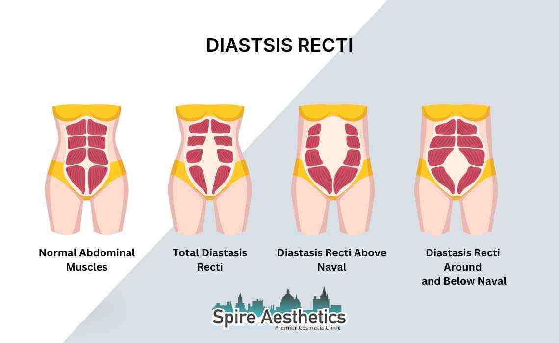 Is Non-Surgical Diastasis Recti Treatment Right for You? Common Concerns Answered Atherstone